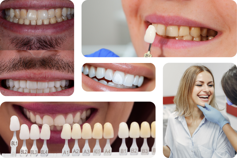 Dental Veneers
