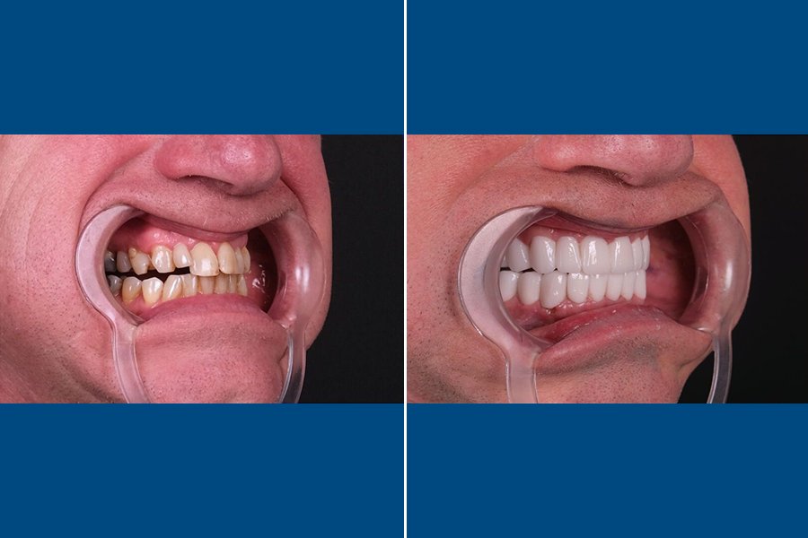 Dental Crowns 1