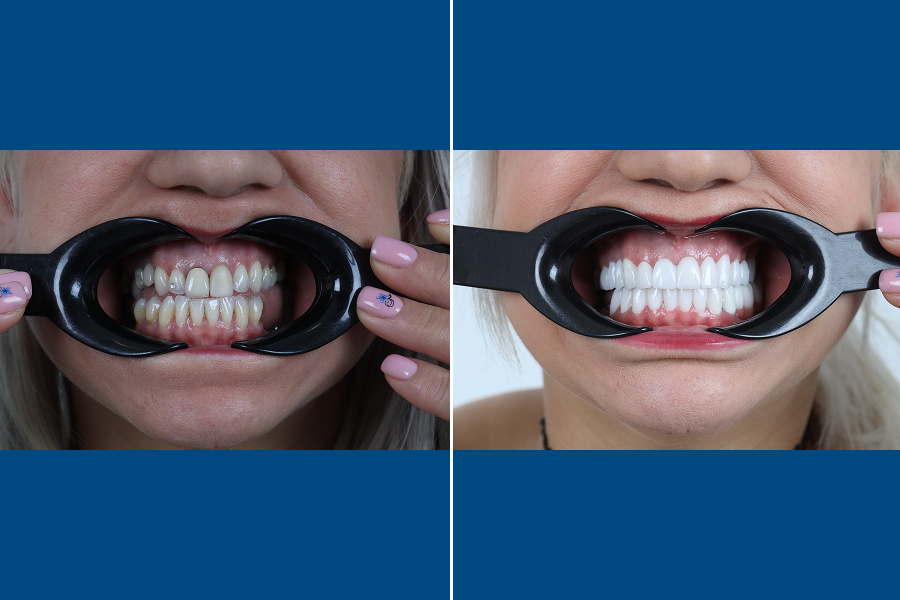 Dental Crowns 3