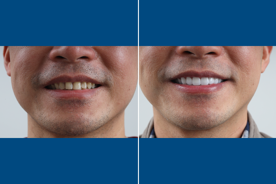Dental Crowns 4