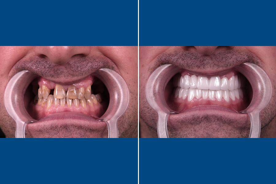 Dental Crowns 2