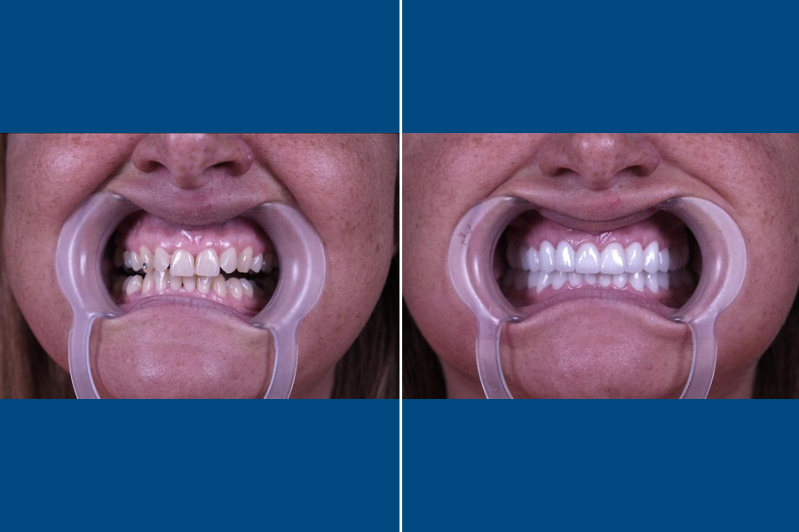 Dental Crowns 5