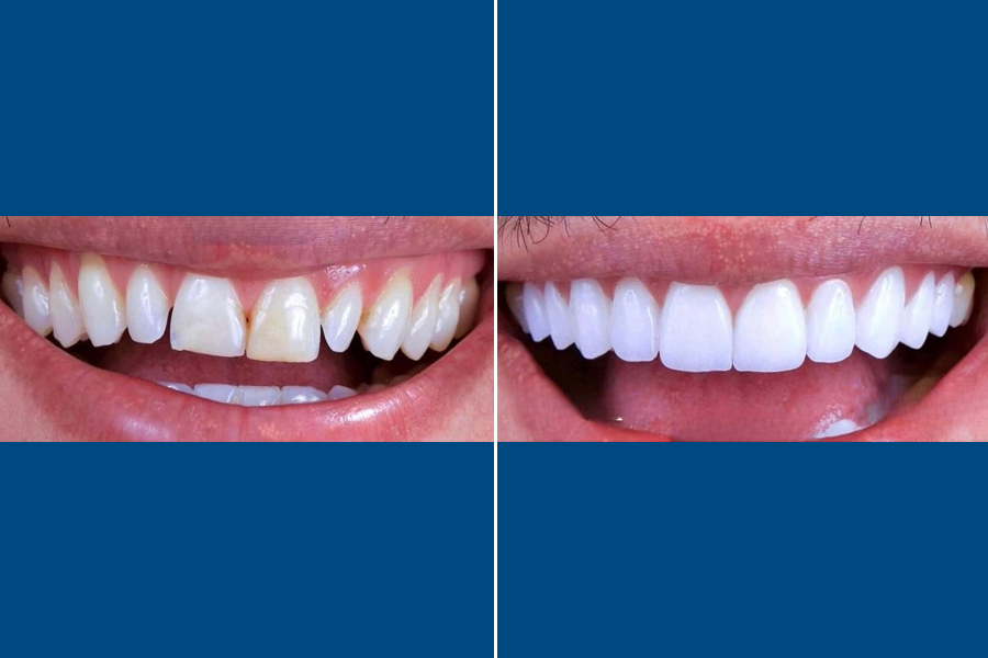 Dental Veneers 3