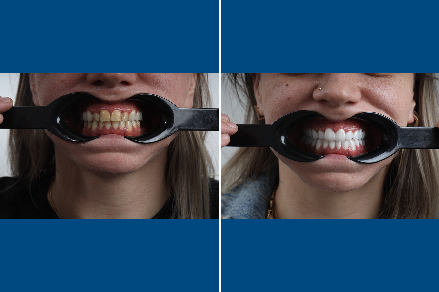 Dental Scaling (Tartar Removal) 1