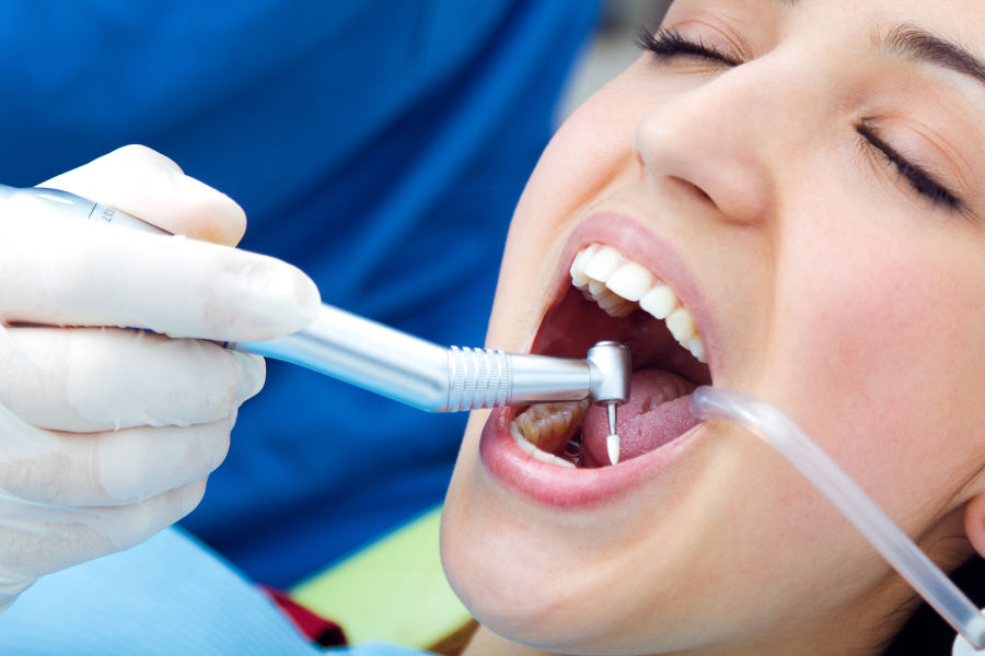 Dental Scaling (Tartar Removal) 4