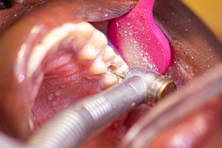 Dental Scaling (Tartar Removal) 5