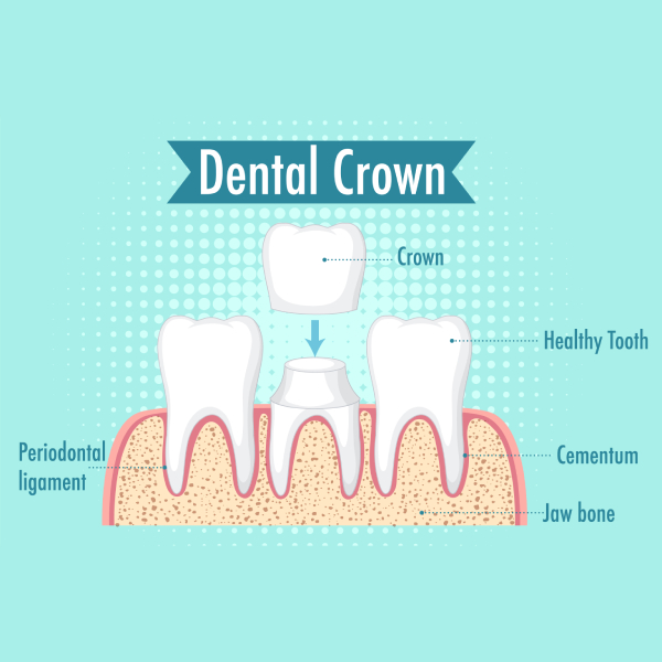 E-Max Crown