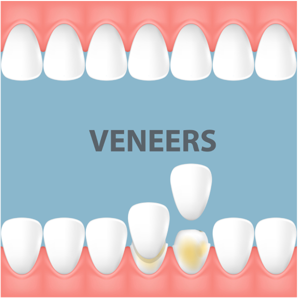 E-max Veneer
