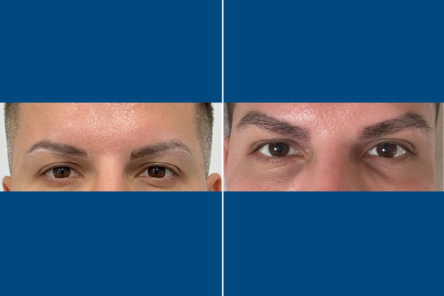 Eyebrow Transplantation: Frame Your Beauty