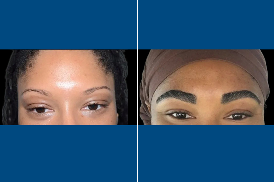 Eyebrow Transplantation: Frame Your Beauty