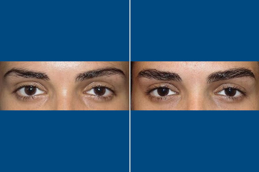 Eyebrow Transplantation: Frame Your Beauty