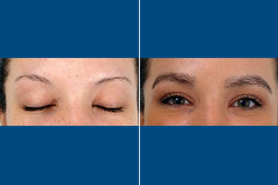 Eyebrow Transplantation: Frame Your Beauty