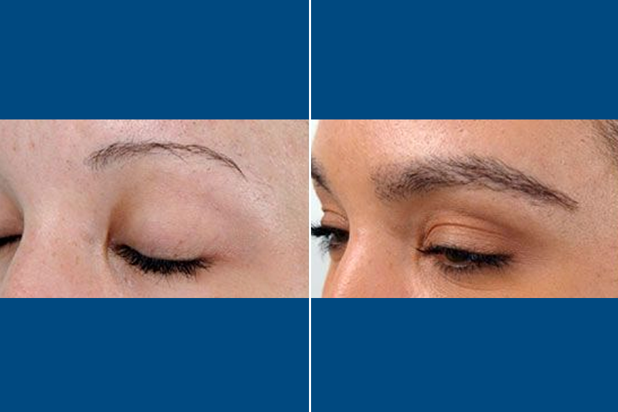 Eyebrow Transplantation: Frame Your Beauty