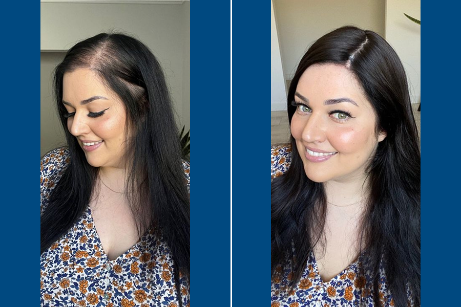 Female Hair Transplantation: Restore Your Radiance