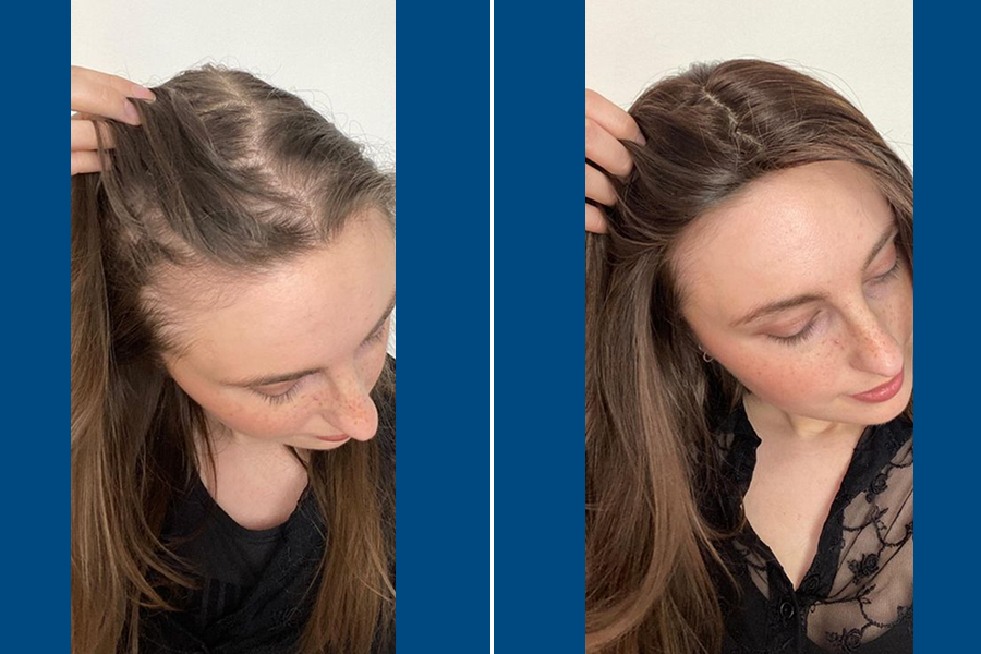 Female Hair Transplantation: Restore Your Radiance