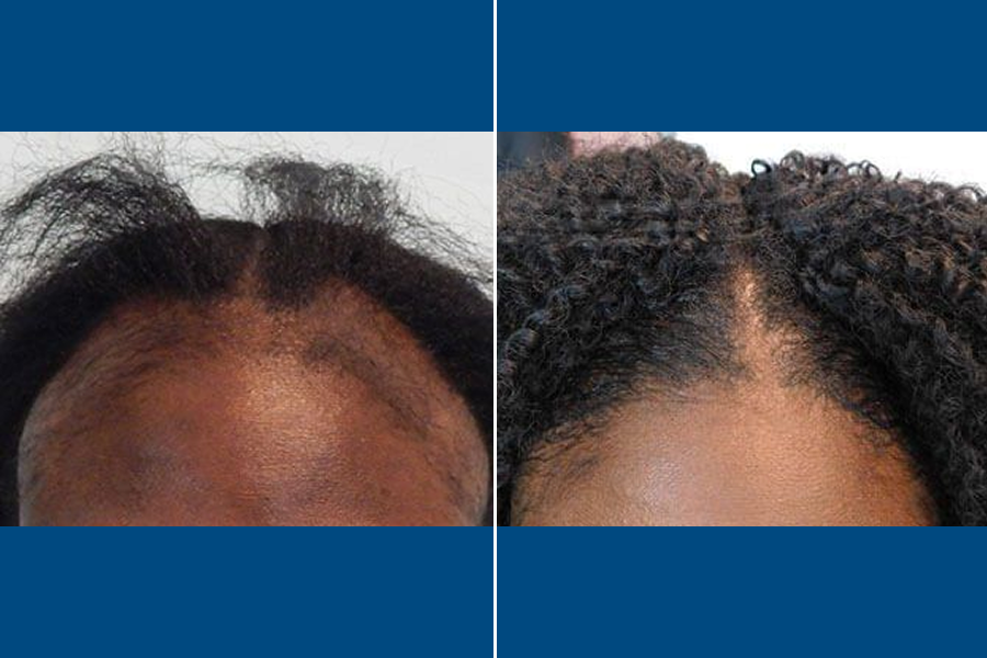 Female Hair Transplantation: Restore Your Radiance