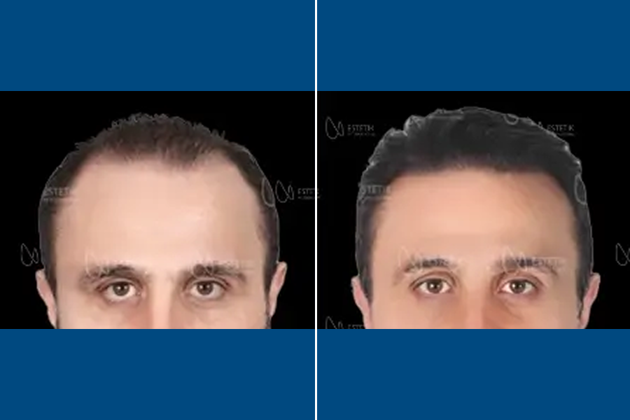 FUE Hair Transplantation: Restore Your Hairline