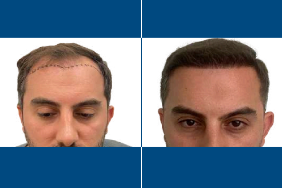 FUE Hair Transplantation: Restore Your Hairline