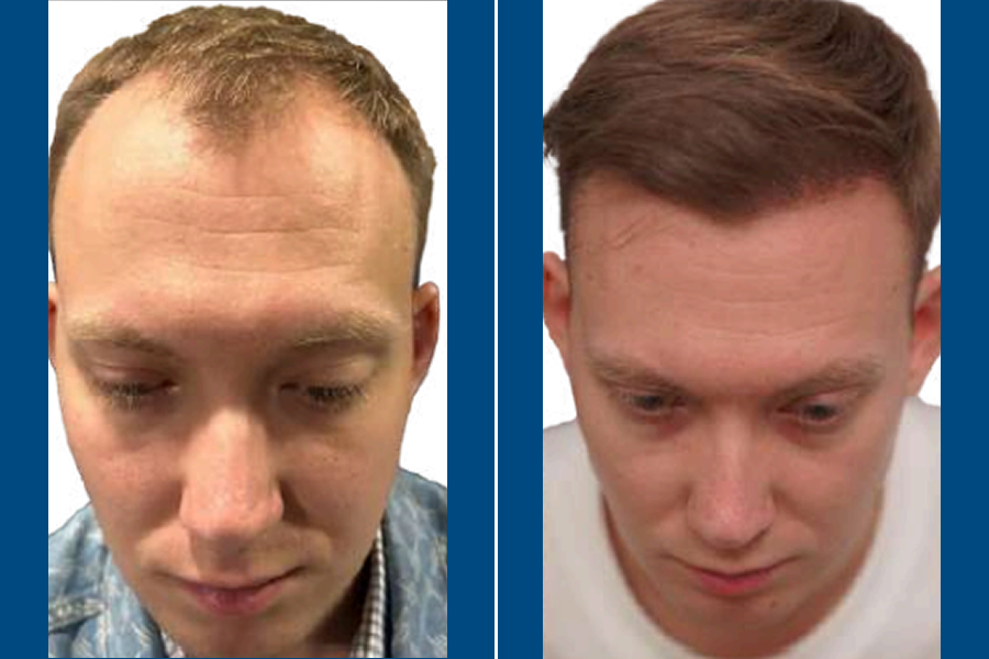FUT Hair Transplantation: Restore Your Hairline