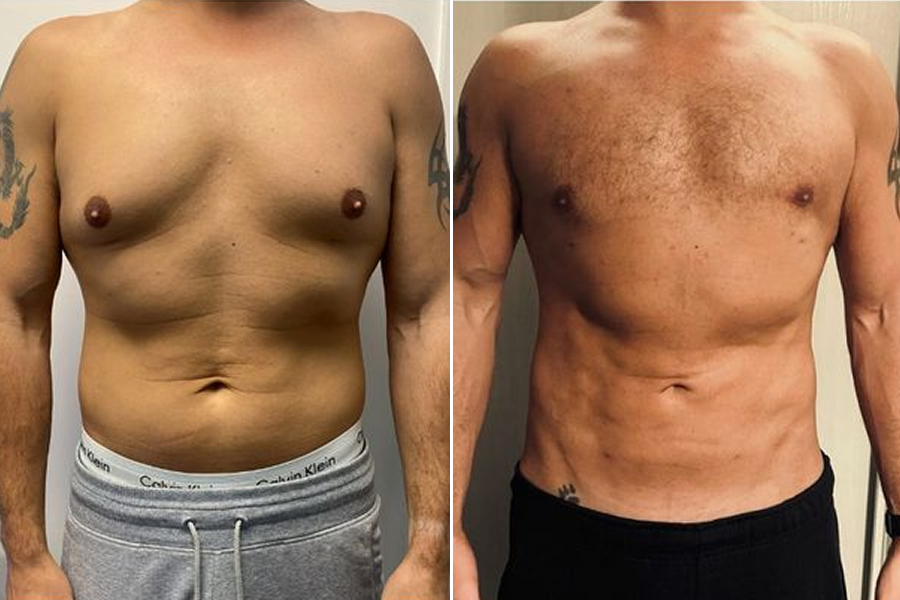 Gynecomastia Surgery