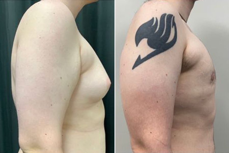 Gynecomastia Surgery