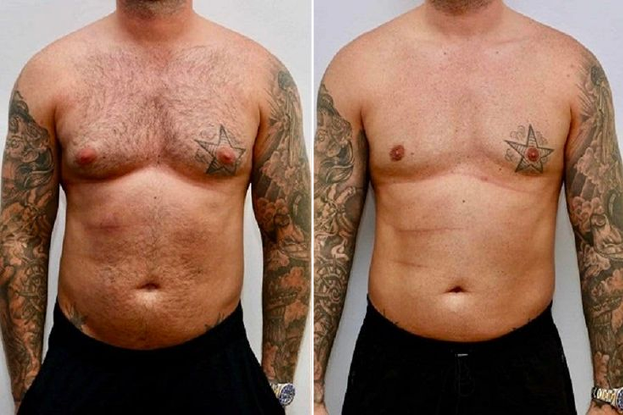 Gynecomastia Surgery
