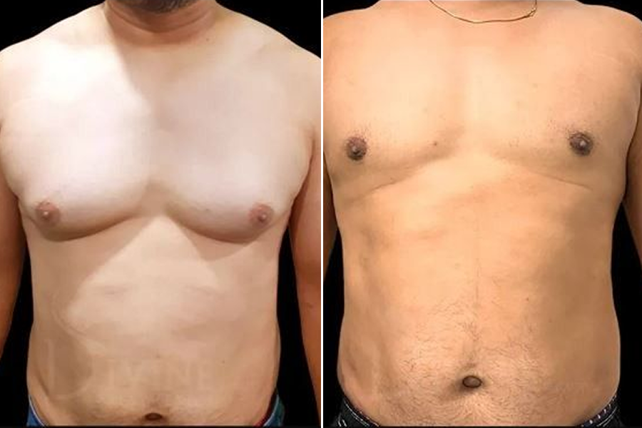 Gynecomastia Surgery