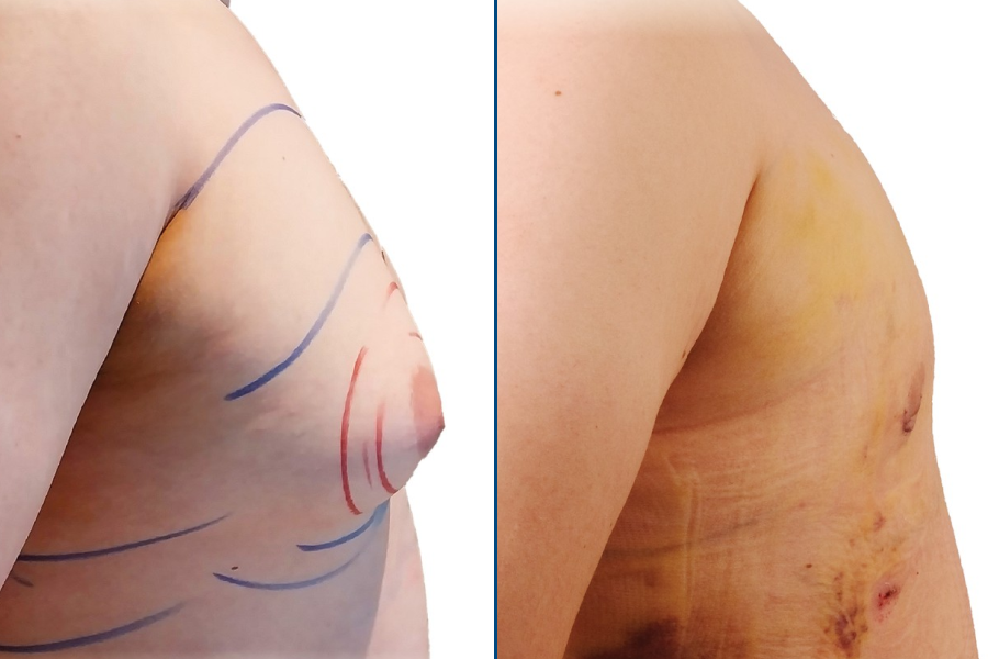 Gynecomastia Surgery