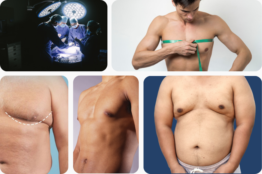 Gynecomastia Surgery
