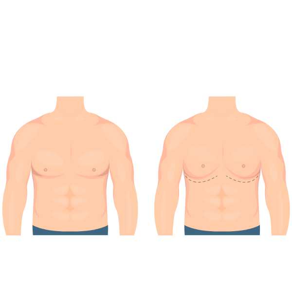 Gynecomastia Surgery