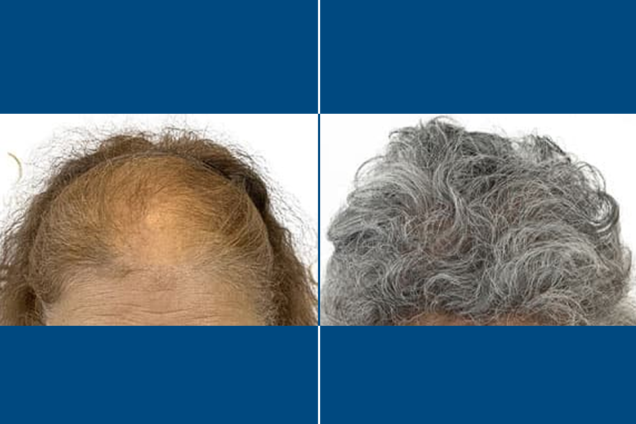 Hair Mesotherapy: Revitalize Your Roots