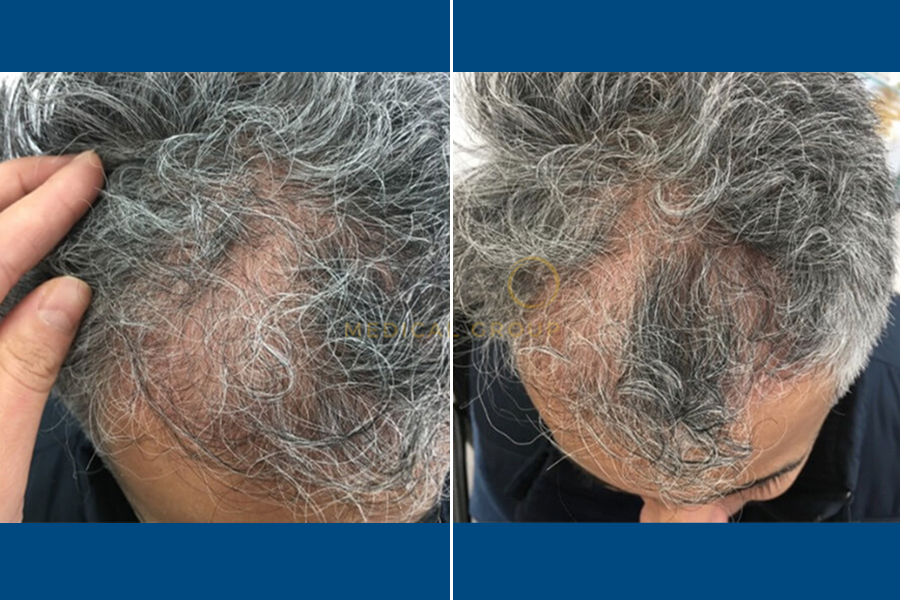 Hair Mesotherapy: Revitalize Your Roots