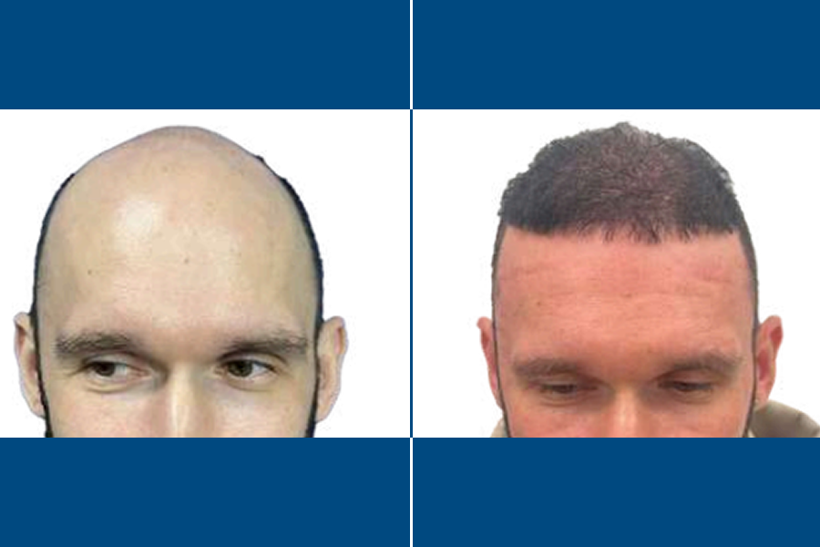 Hair Transplantation: Restore Your Confidence