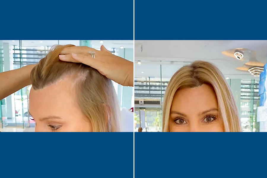 Hair Transplantation: Restore Your Confidence