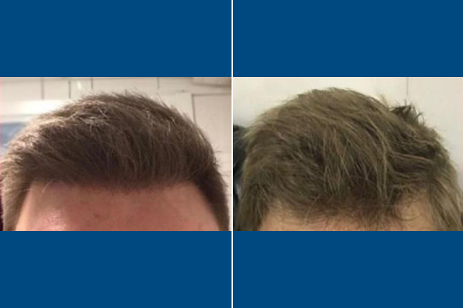 Hair Transplantation: Restore Your Confidence