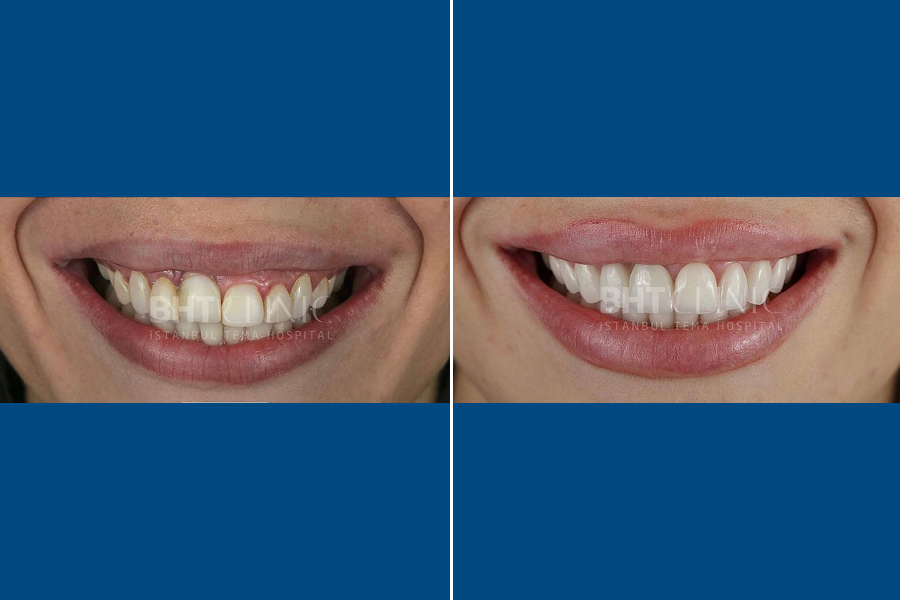 Hollywood Smile 1