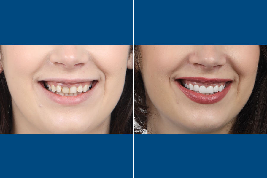 Hollywood Smile 4