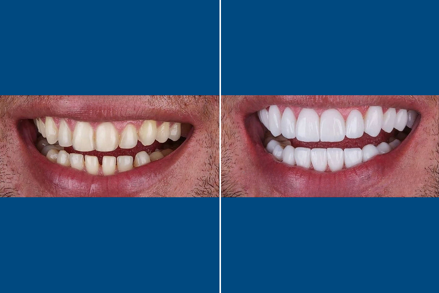 Hollywood Smile 3