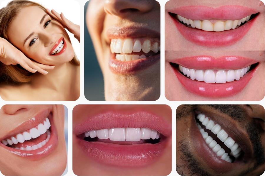 Hollywood Smile