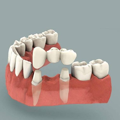 Dental Bridges