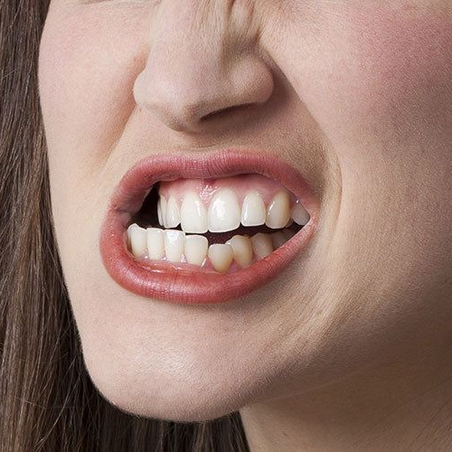 Teeth Grinding Treatment (Bruxism)