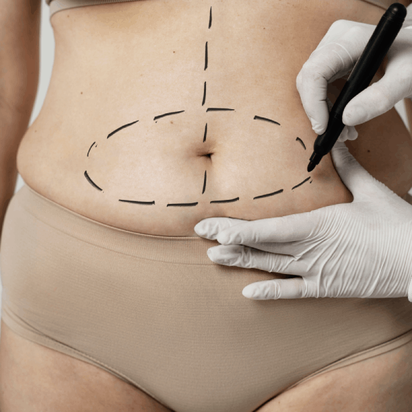 Tummy Tuck