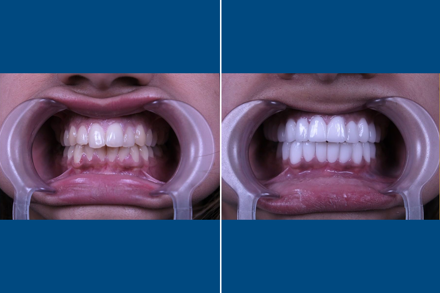 Invisalign Clear Aligners 4