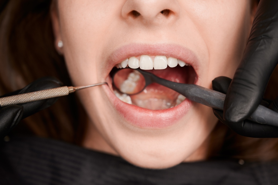 Root Canal Treatment 2