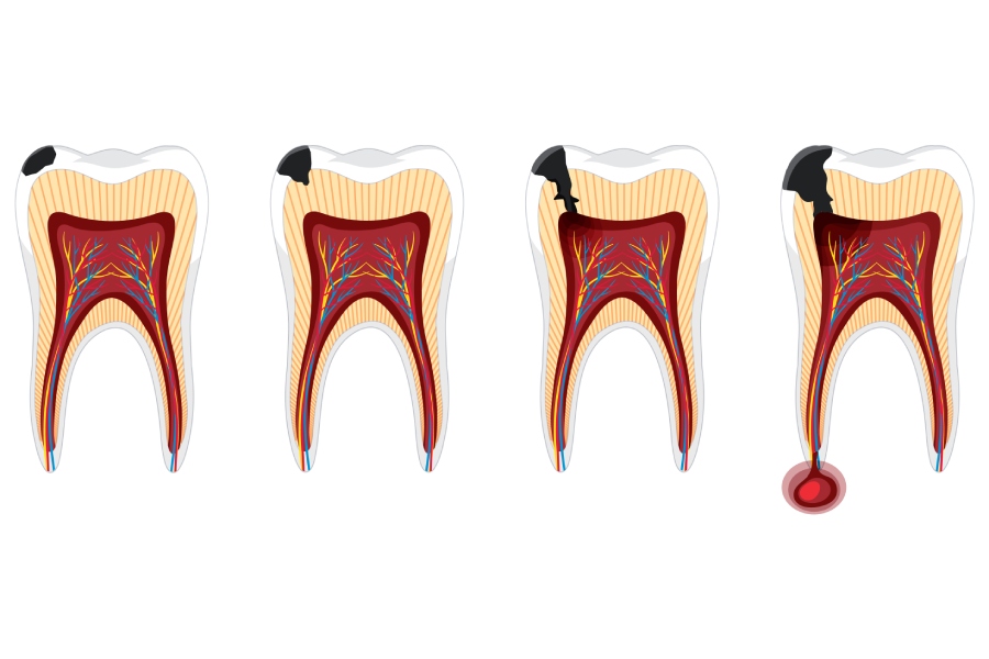 Root Canal Treatment 4