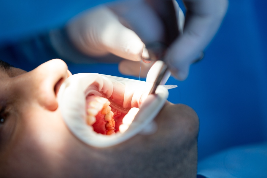 Root Canal Treatment 3