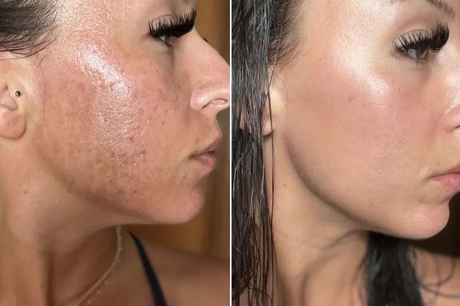 Laser Skin Resurfacing