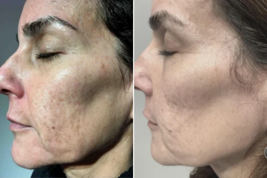 Laser Skin Resurfacing