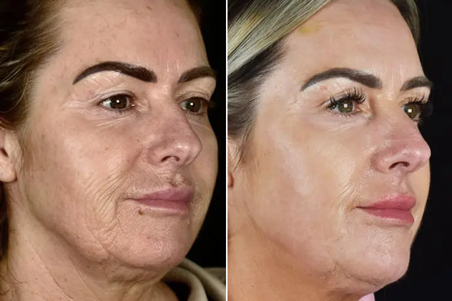 Laser Skin Resurfacing