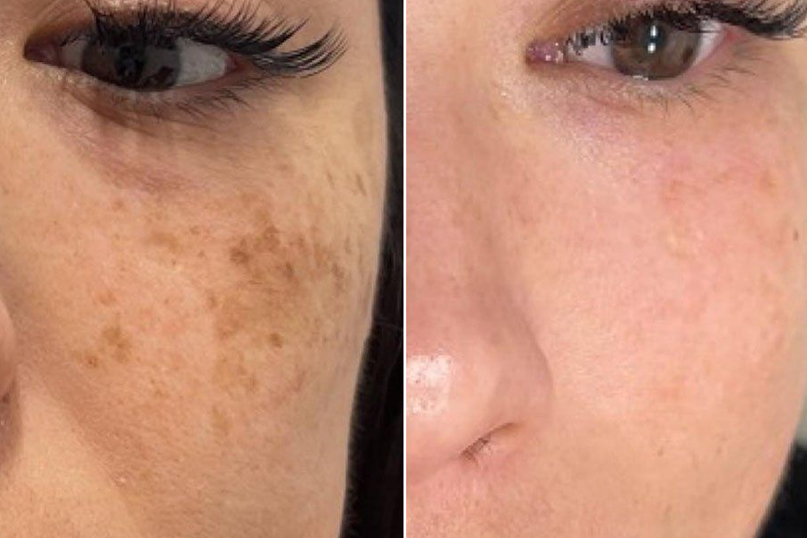 Laser Skin Resurfacing